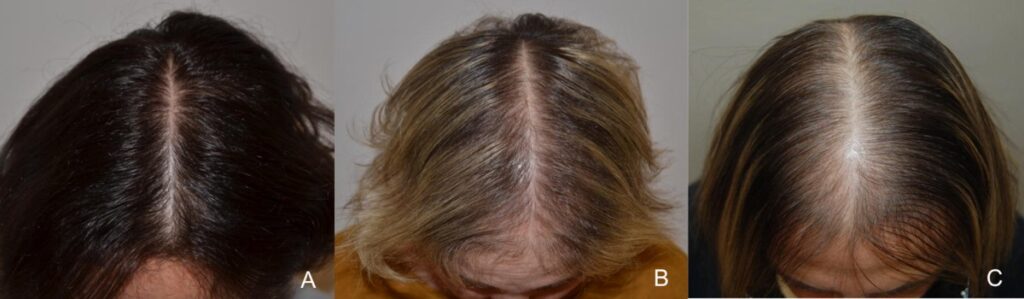 Androgenetische alopecia bij mannen en vrouwen: oorzaken, behandeling en natuurlijke ondersteuning, de rol van feungriekolie 40257 2019 479 fig2 html